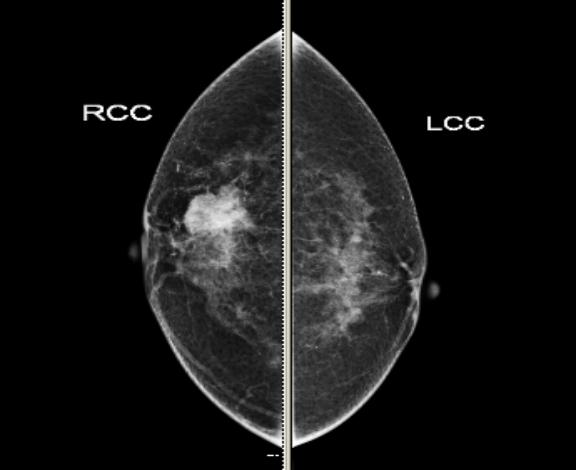ge钼靶机怎么打印高唐县人民医院先进设备（七）｜美国GE全数字化平板乳腺钼靶机_https://www.jmylbn.com_新闻资讯_第5张