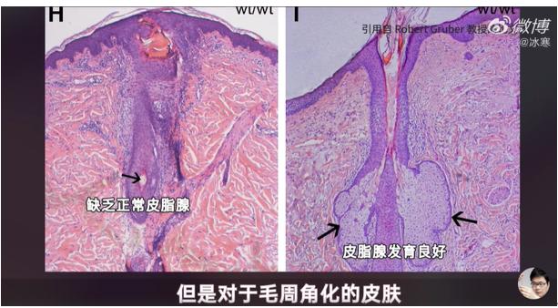 皮脂腺切片图片