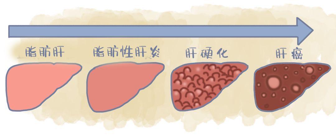 別把脂肪肝不當病從脂肪肝到肝癌只需要4步