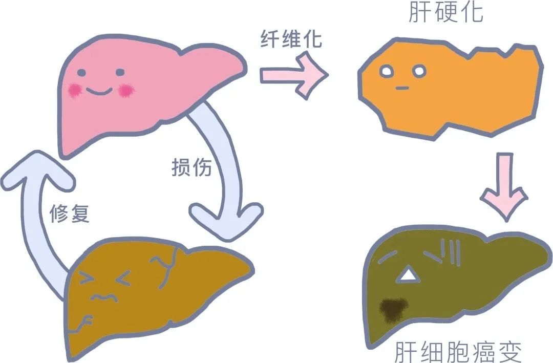 從脂肪肝到肝癌,只需四步03值得注意的是,中,重度脂肪肝會有類似慢性