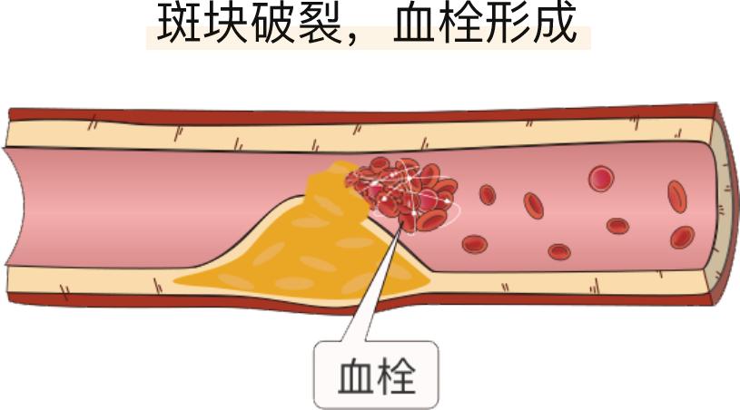 脑栓塞示意图图片