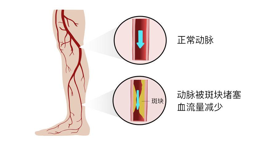 堵在下肢血管 =下肢缺血脑梗则是颈动脉或颅内血管堵塞了