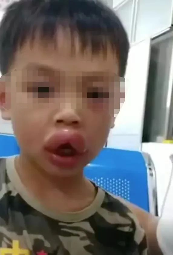 引起了大家的围观 近日,广西桂林 一名4岁半男孩吃葡萄过敏 嘴巴肿成"