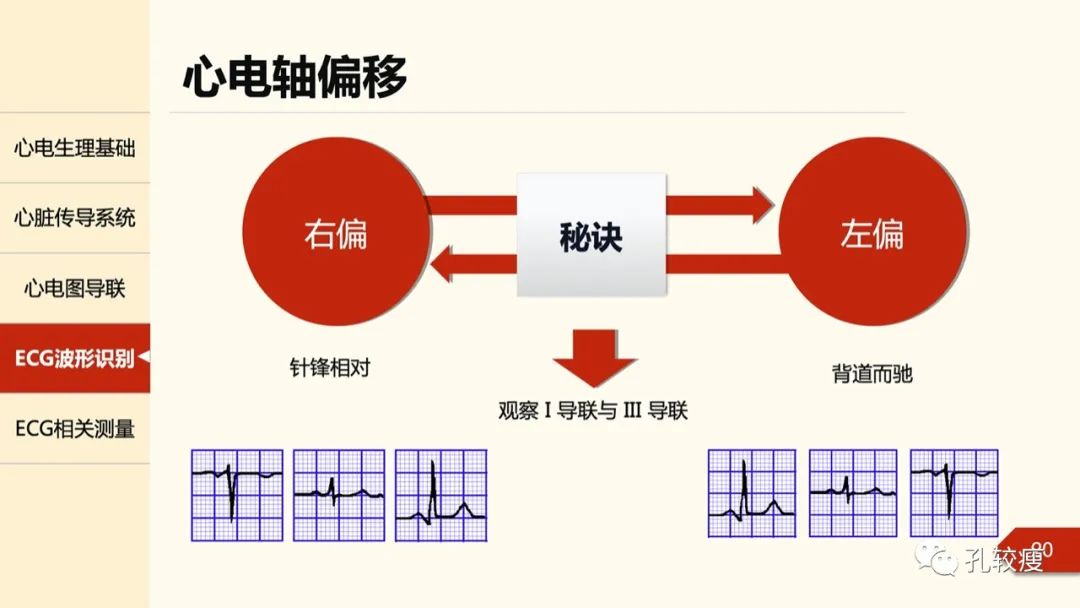 心電圖診斷入門導聯基礎及圖形識別