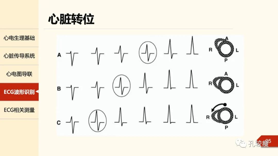 心电图诊断入门导联基础及图形识别