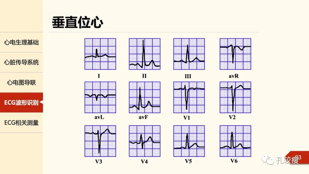 心电图诊断入门:导联基础及图形识别
