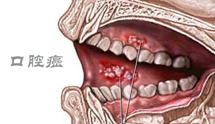 口腔內被學術上廣泛認可的癌前病變主要有白斑和紅斑.