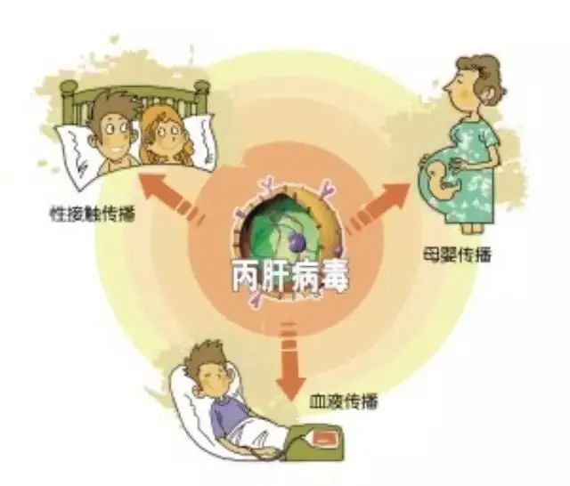 感染丙肝后,患者少数会出现乏力,食欲减退,低烧,黄疸等急性肝炎症状