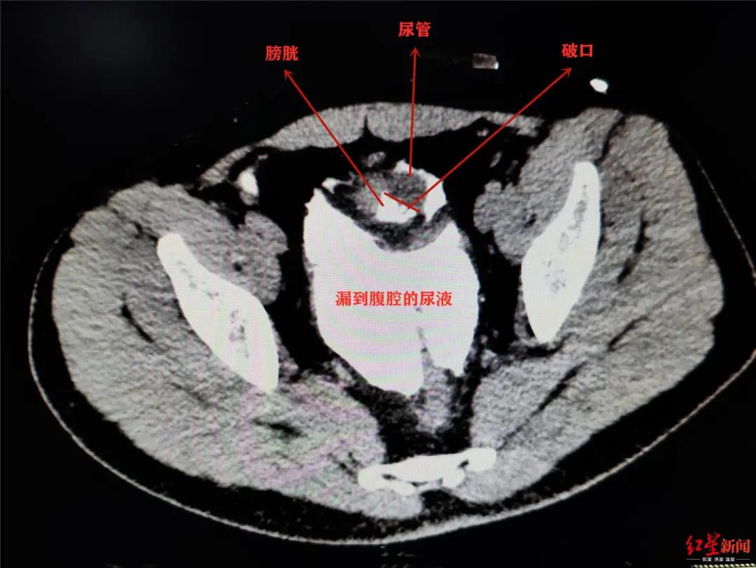 酒后憋尿摔一跤,成都小伙子膀胱磕破了.