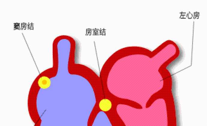 這時候該植入起搏器了——認識房室傳導阻滯