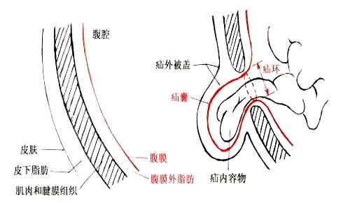 小肠下垂到阴囊的图片图片