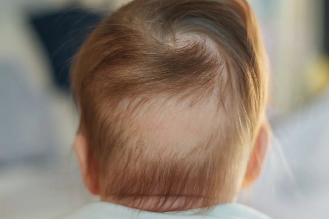 婴儿缺钙头发症状图片图片