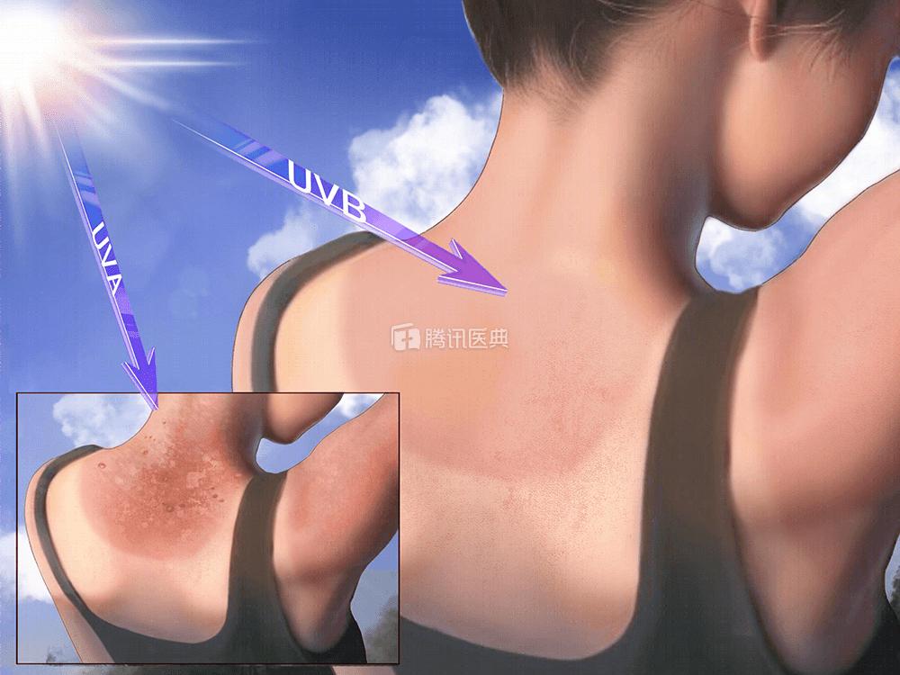 而紫外线是皮肤最大的杀手,不仅会晒伤,还会晒黑,晒丑,晒出皮肤癌.