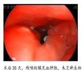 长期抽烟喝酒咽喉不适警惕喉癌发出的这些信号