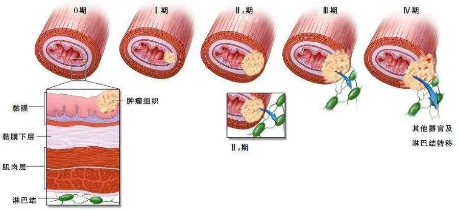 为什么会得食道癌图片