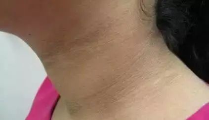 是一种皮肤色素增生,角化过度,天鹅绒样增生至疣状改变为特征的皮肤病