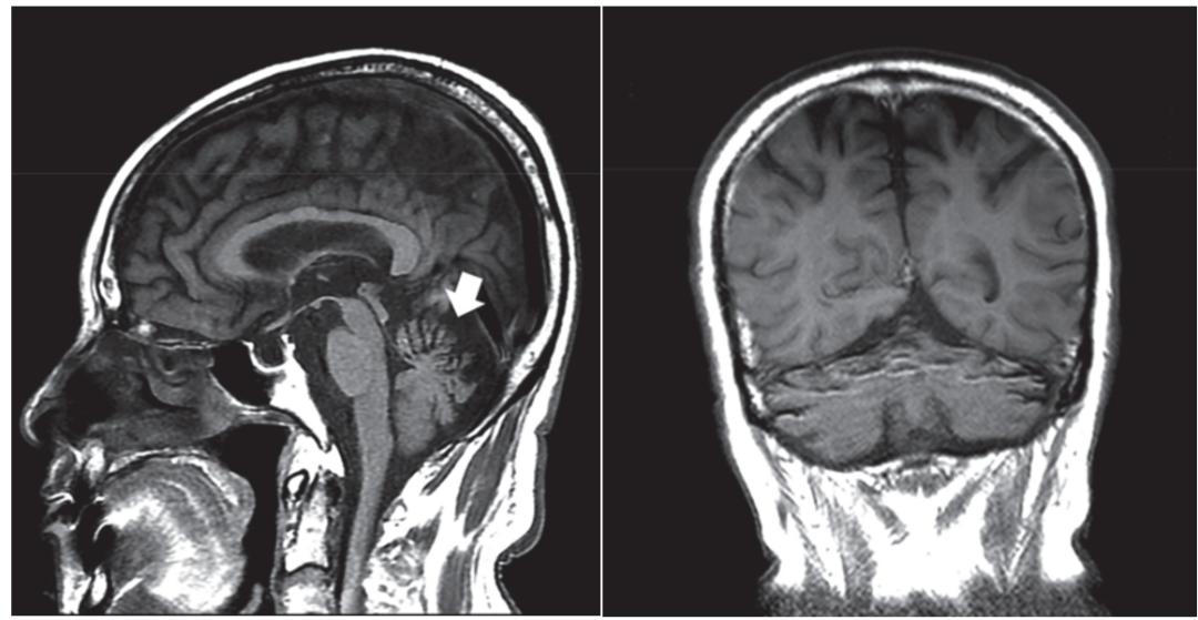 颅脑mri示小脑萎缩,尤其是在小脑蚓部和半球的的前部