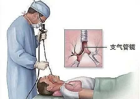 聊城市人民医院东昌府院区引进新型纤维支气管镜急危重症患者诊治又添