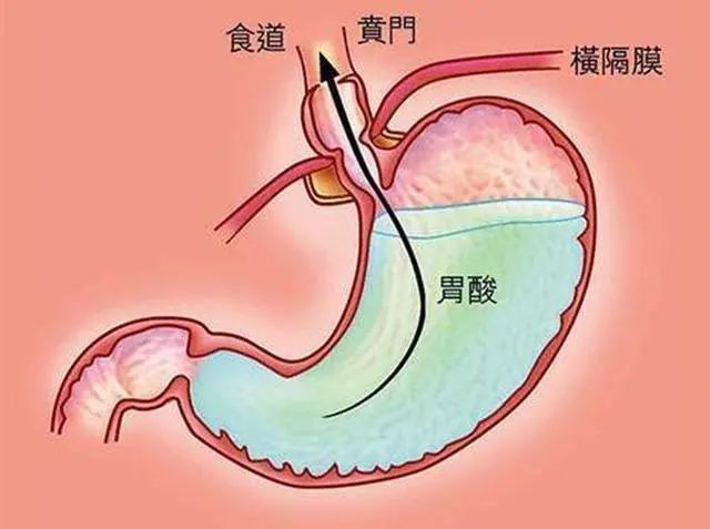 全麻誘導時因患者的意識消失,咽喉部反射消失,因此也成了反流誤吸的