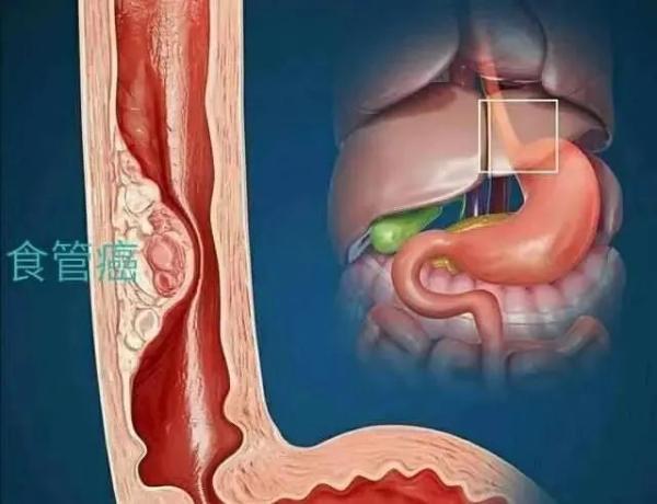 食道癌死前一天症状图图片