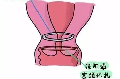 宫颈环扎线图片图片