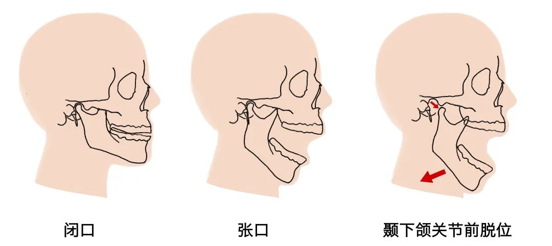 髁状突滑到颞下颌窝的前下方,常常是不能自行恢复原位,出现闭口困难