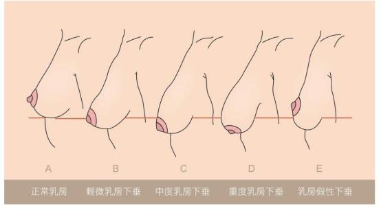 造成乳房下垂的真凶是 Ta 湃客 澎湃新闻 The Paper