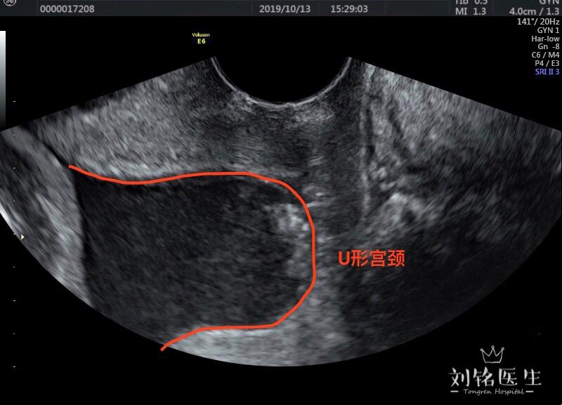 宫颈长短和流产早产是否有关
