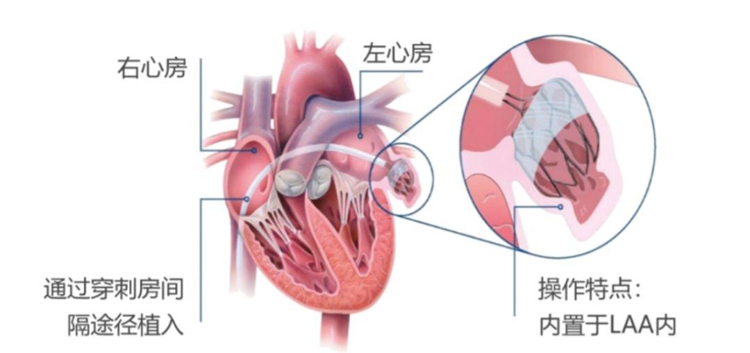 5次消融失败 房颤反复发作 这个方法带他走出噩梦 湃客 澎湃新闻 The Paper