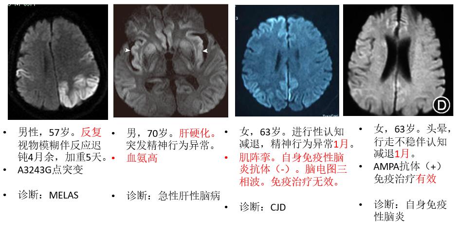 病,可逆性脑血管收缩综合征,尿毒症患者的血氨代谢异常,线粒体脑病