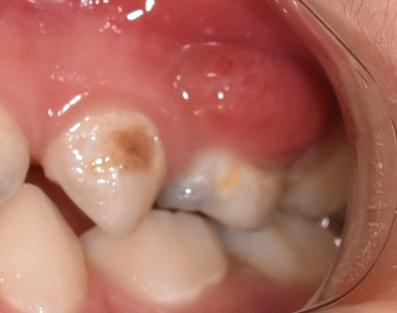 儿童口腔牙龈囊肿图片图片
