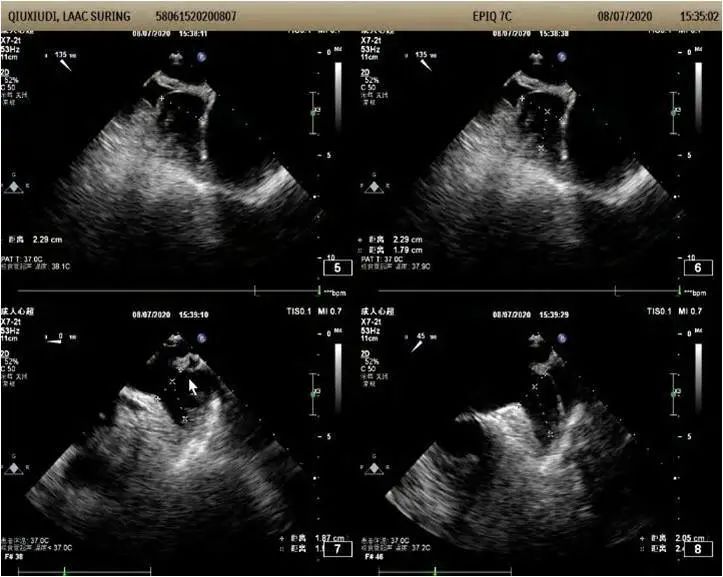 左心耳超声图图片