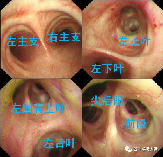 支气管镜入门图谱图片