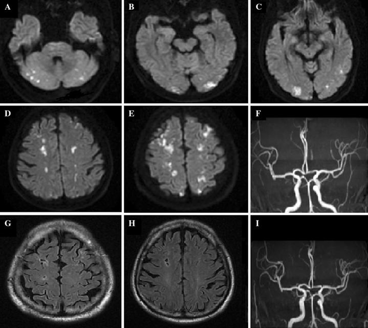 一文揭开分水岭脑梗死的真面目