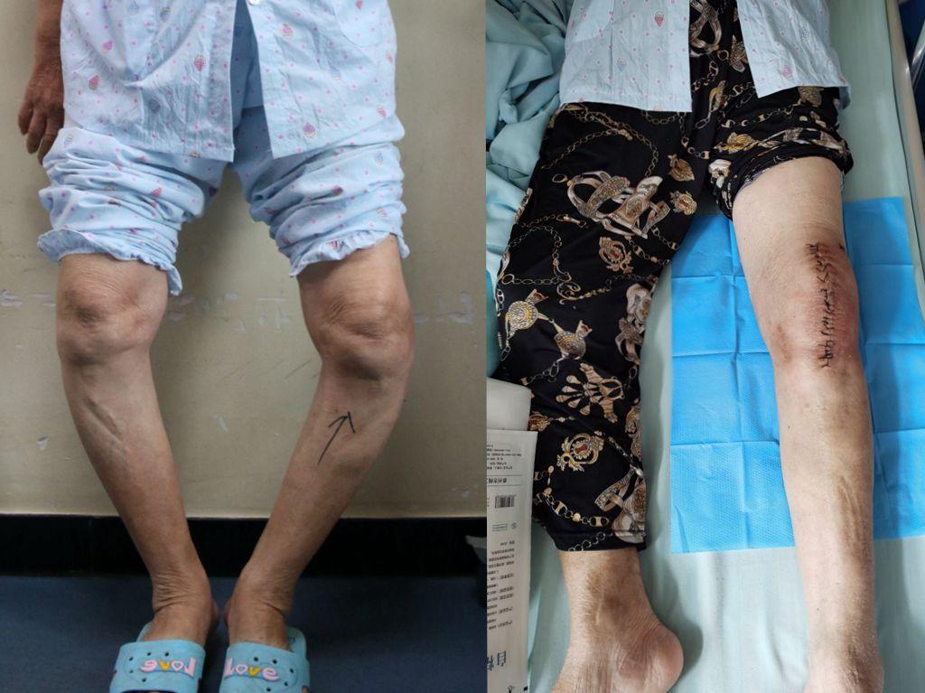 膝盖刺痛像被针扎7年弯成o形腿连江七旬依姆最终竟选择