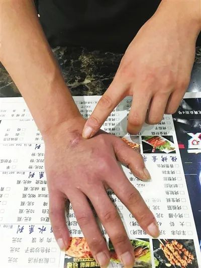 警惕丨大窯爆瓶賀蘭18歲服務員右手被炸傷1個月突發2次