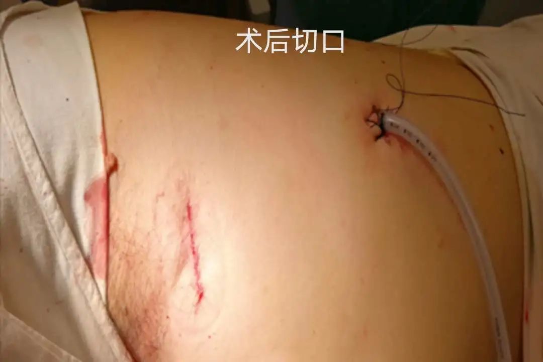 胸中有术胸腔镜微创手术告别昔日大切口