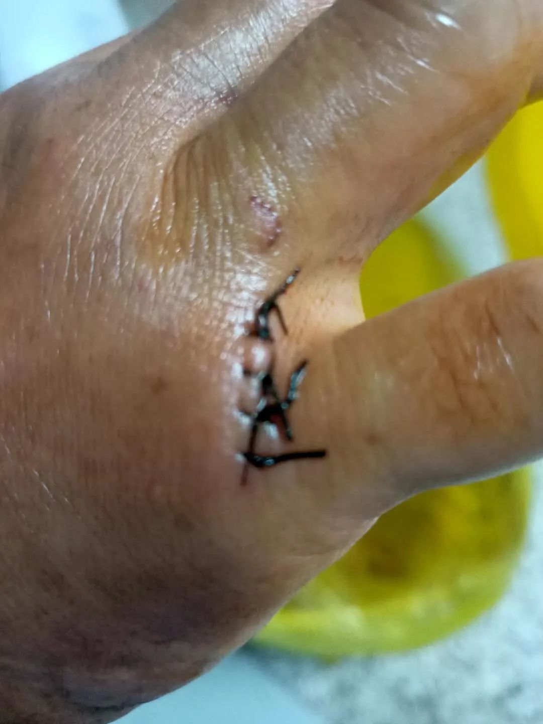 徐州人注意了雪花啤酒瓶突然爆炸男子右手鲜血直流