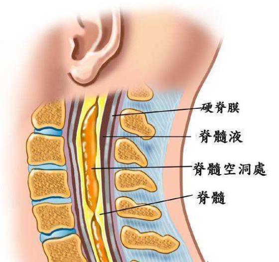 了椎管后,就像一个塞子一样堵在那里,使得脑脊液不能下流到脊髓中央管