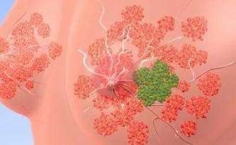 乳腺癌患者的一次性放疗癌症复发率跟踪