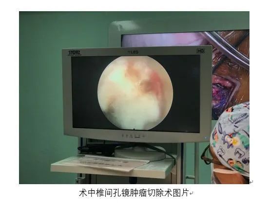 脊柱微创男子脊椎管内大哑铃状肿瘤九院骨科脊柱微创成功摘除