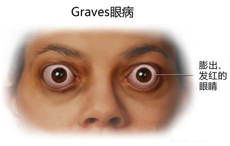 臨床上80%以上甲亢是由graves病引起的,graves病的病因尚不明確,目前