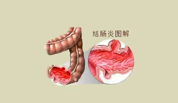 潰瘍性結腸炎的主要症狀是腹瀉腹痛,裡急後重,黏液膿血便等,常反覆