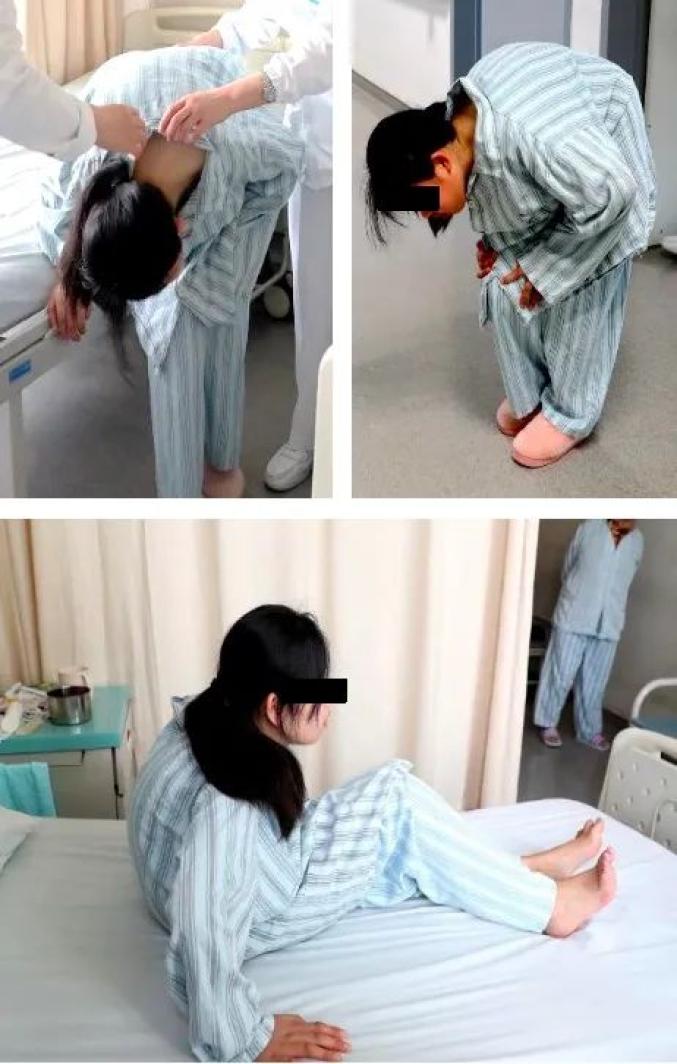 炎晚期,重度脊柱后凸畸形合并双髋关节强直,是临床上罕见的"折叠人"