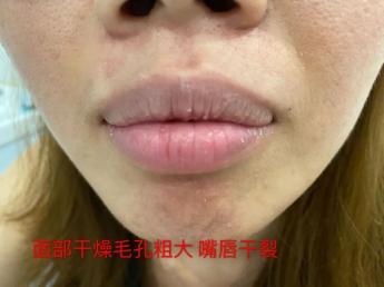 唇干鼻干咽干大便干 怎么喝水都没用