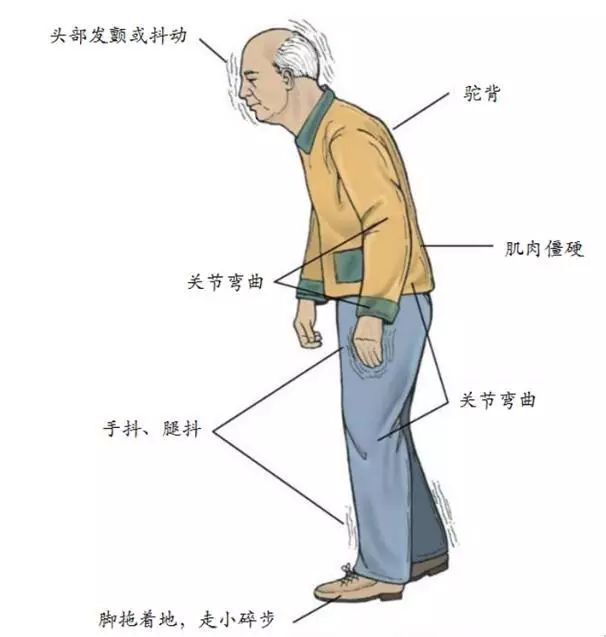 健康贴士2020年老年健康周如何预防帕金森病