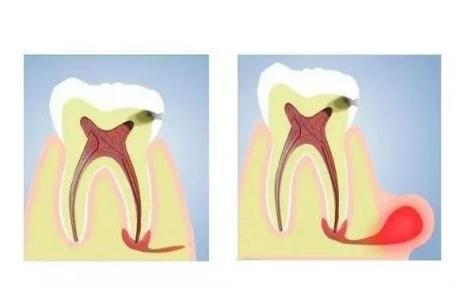 牙肉長膿包根尖周炎在搞鬼