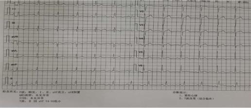 25 mg 每晚一次,门冬氨酸钾镁2片,每日三次口服等治疗后患者心电图