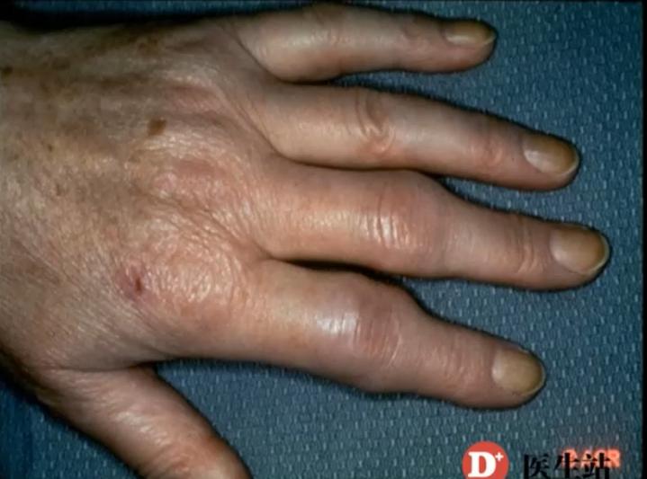 如何区分关节痛与关节炎?揭秘你不知道的风湿病真相