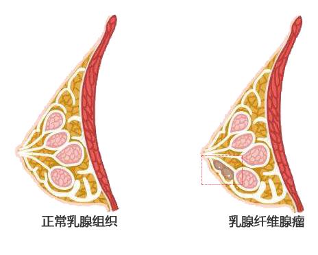 查出這些乳腺疾病別太著急大部分是良性的